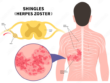 Shingles Virus
