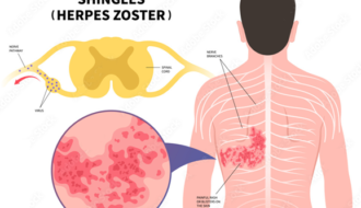 Shingles Virus