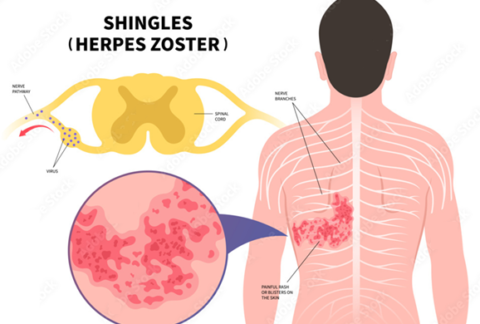 Shingles Virus