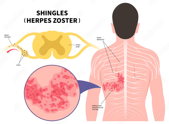 Shingles Virus